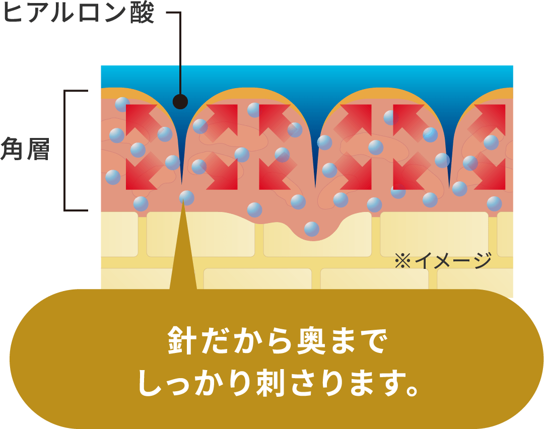 各層の間に、針がしっかり刺さってヒアルロン酸が届きま